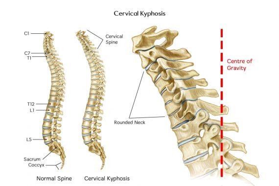 Cervical Kyphosis