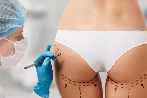 Brazilian Butt Lift - Medworld Esthetic Clinic